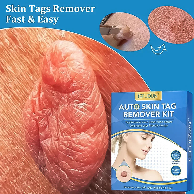 Skin Tag Removal Kit | Painless wart remover
