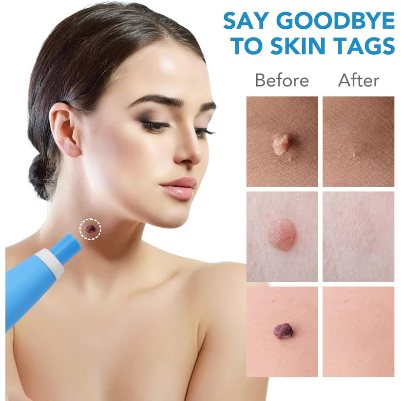 Skin Tag Removal Kit | Painless wart remover